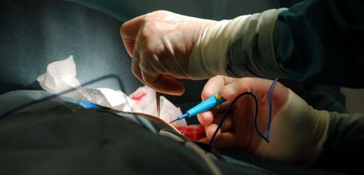 Lékaři voperovali srdeční podporu pacientce jen malým řezem v mezižebří (ilustrační foto).