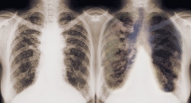 Pro srovnání: zdravé a nemocné (vpravo) plíce.