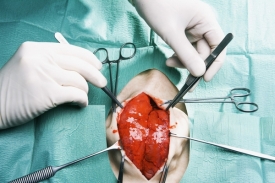 Umělá srdeční chlopeň byla poprvé voperována před 50 lety.