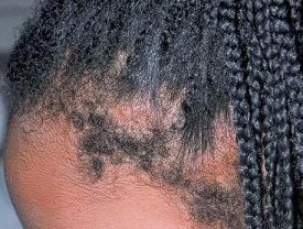 Vlasy mohou vypadat v místech spletených copánků.