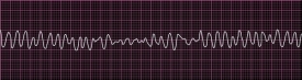 Defibrilátor elektrickými výboji dává srdci správný rytmus.