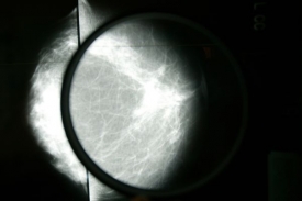 Vyšetření na mamografu spolehlivě odhalí rakovinu prsu.