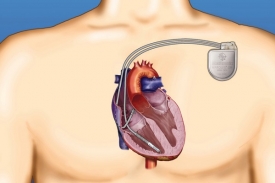 Kardioverter-defibrilátor lze kontrolovat bezdrátově na dálku.