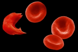 Červená krvinka postižená srpkovou anémií vedle zdravých krvinek.