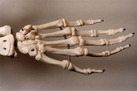 Artritida často postihuje několik kloubů najednou.