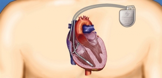 Kardiostimulátory a ICD přístroje se vkládají pod klíční kost, elektrody vedou do srdce.
