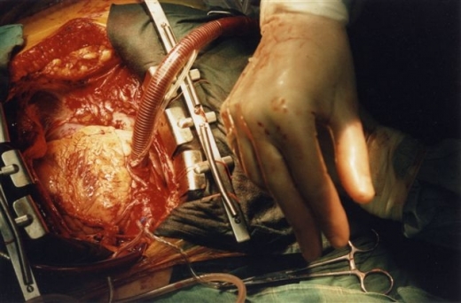 Operace srdce (ilustrační foto).