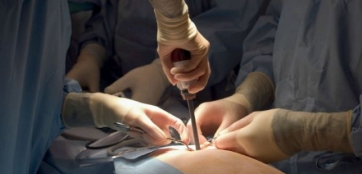 Jednoportová laparoskopie není běžná ani v zahraničí. Lékaři zatím sbírají zkušenosti (ilustrační foto).