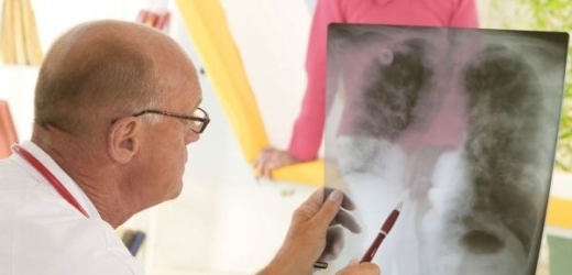 Rakovina plic a hrtanu by mohla brzy patřit k nemocem z povolání (ilustrační foto).