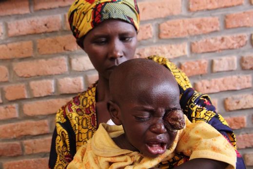 Matka přišla do nemocnice pozdě. Její syn s obřím nádorem v oku zemře. Rwanda 2010. 