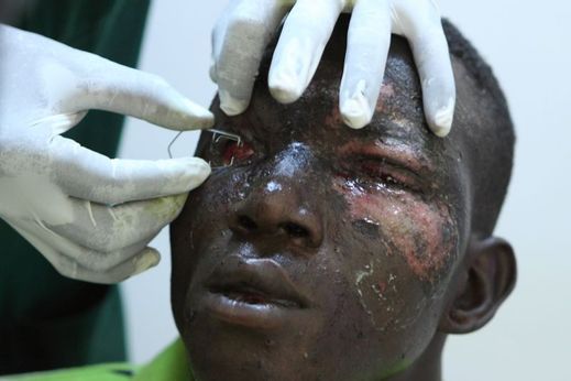 Mladík, který v podstatě oslepl po výbuchu nálože ve zlatém dole v Burkině Faso. 