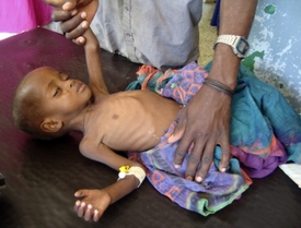 Asi 640 tisíc somálských dětí je těžce podvyživených.