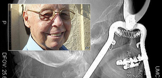 Na rentgenovém snímku je vidět, že rukojeť nůžek projela očním důlkem až do krku. Ve výřezu  Leroy Leutscher.