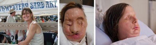 Ženě, kterou napadl šimpanz, transplantoval obličej právě Pomahač.