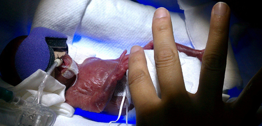 Melinda Guidová krátce po narození. Na tomto snímku váží 270 gramů.