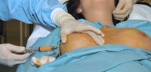 Výměnu prsních implantátů mají zaplatit nemocnice, tvrdí právník Ondřej Dostál.