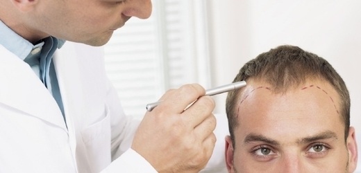 Osm z deseti evropských mužů pod sedmdesát let má problémy s úbytkem vlasů.