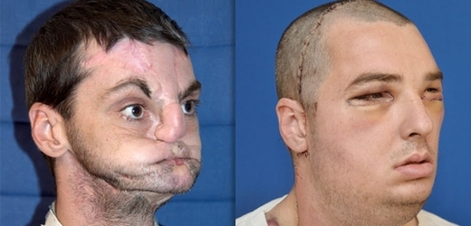 Muž přišel o obličej při divoké přestřelce. Vlevo před operací, vpravo po úspěšném zákroku.