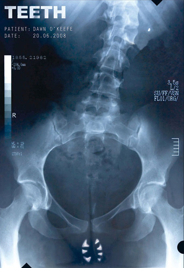 Tvůrci filmu Intimní tajemství (2007) si s plakátem opravdu nedělali hlavu. Zobrazuje rentgenový snímek dívky s umělým chrupem v intimních místech.