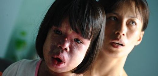 Ve Vietnamu se kvůli Agent Orange stále rodí zmrzačené děti.