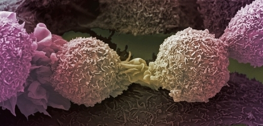Rakovina plic patří mezi nejhůře léčitelné druhy tohoto onemocnění.