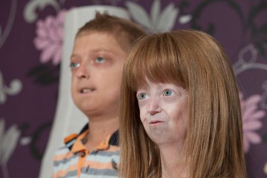 Hailey a Harry patří mezi 78 dětí, které trápí syndrom předčasného stárnutí.