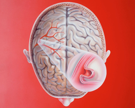 Mozková mrtvice je náhlé postižení určité části mozku vzniklé poruchou jejího prokrvení.