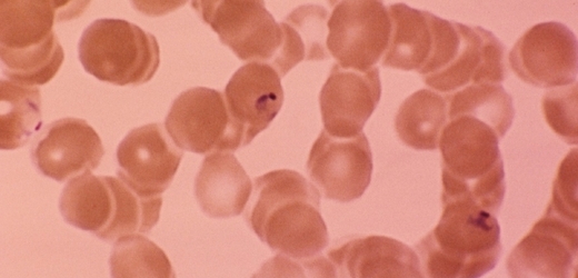 Zimnička Plasmodium falciparum v krvi.