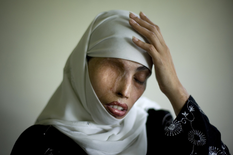 IRÚM SAÍD. Třicetiletá žena, která odmítla manželství. Zhrzený muž se jí pomstil politím kyselinou, která jí spálila tvář, záda a ramena. Podstoupila pětadvacet plastických operací. (Foto: ČTK/AP)