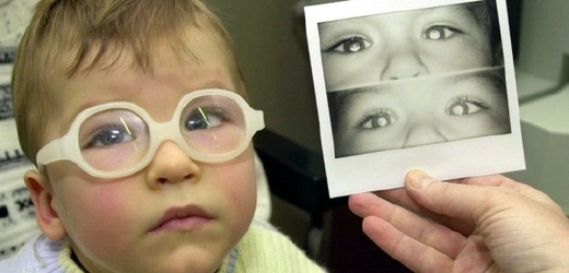 Neléčená tupozrakost zvyšuje až o 50 procent riziko oslepnutí (ilustrační foto).