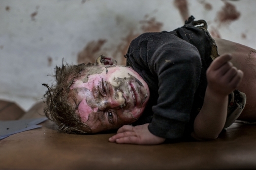 Popálený chlapec v Aleppu.