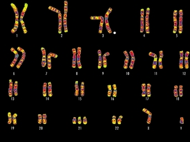 Sada chromozomů jedince s Downovým syndromem. Povšimněte si jednoho přebývajícího čísla 21.