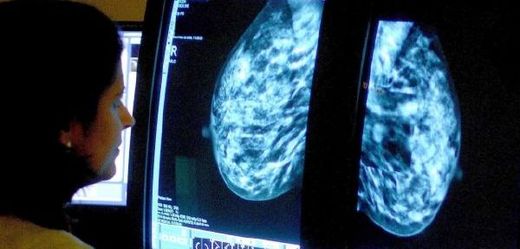 Vyšetření na mamografu odhalí skrytá rakovinová ložiska, která žena sama nemůže odhalit (ilustrační foto).