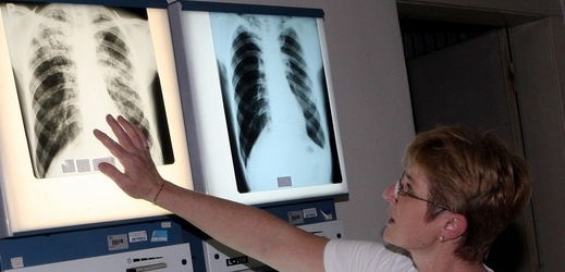 Tuberkulóza stále hrozí (ilustrační foto).