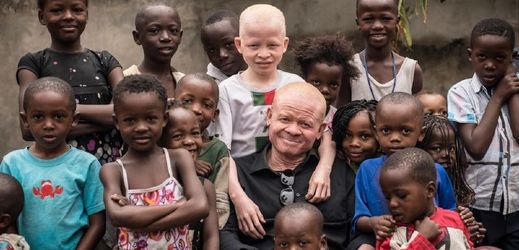 Narodit se jako albín a ještě k tomu v Tanzánii, je dost nešťastná kombinace (ilustrační foto).