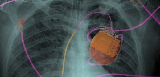 Přejete si kardiostimulátor "ojetinu", vyříznutý z nebožtíka?