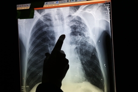 Pokud je rentgenový snímek znepokojivý, je pacient z dodávky poslán do nemocnice na testy.