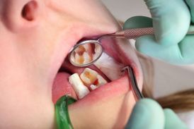 Pokud ministerstvo zubařům nepřidá peníze, vyvrtání zubu a plombu bude muset každý pacient zaplatit hotově.