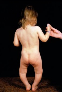 Dítě trpící křivicí (ilustrační foto).