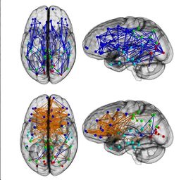 Nahoře vidíme mužský mozek, který lépe propojuje přední a zadní části jednotlivých hemisfér, zatímco u žen je to jinak. Lépe jim spolupracují levá a pravá část orgánu.