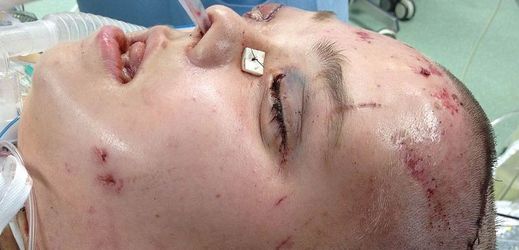 Polští lékaři podnikli druhou transplantaci tváře.