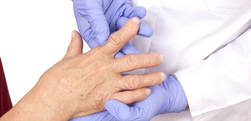 Představuje zjištění harvardských vědců naději pro pacienty s revmatoidní artritidou? Někteří odborníci jsou skeptičtí (ilustrační foto).
