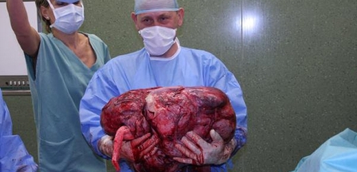 Lékaři ve zlínské nemocnici vyoperovali v polovině prosince z těla sedmačtyřicetileté pacientky zhoubný nádor o hnotnosti 36 kilogramů.