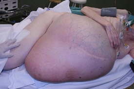 Pohled na tělo pacientky, z něhož lékaři při náročné operaci odstranili obrovský nádor.
