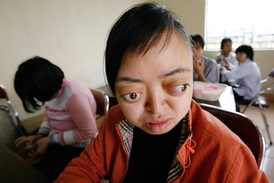 Nyní sedmadvacetiletá Nguyen Thi Van Long se narodila s postižením zřejmě kvůli americkým herbicidům (snímek z roku 2006).