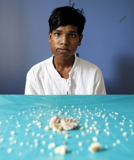 Sedmnáctiletý Ashik Gavai trpí vzácným nádorem.