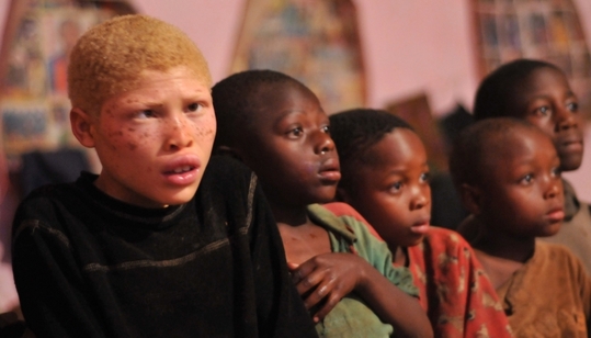Zvláště ohrožení jsou v Africe albíni. Žádané jsou jejich kosti.