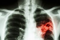 Česko patří k zemím s nejnižším výskytem TBC (ilustrační foto).