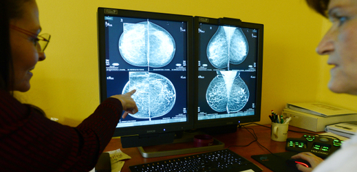 Nový mamograf je přínosem hlavně pro mladší ženy.