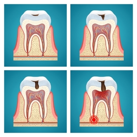 Ignorování zubního kazu vede k vážnějším komplikacím (ilustrační foto).
